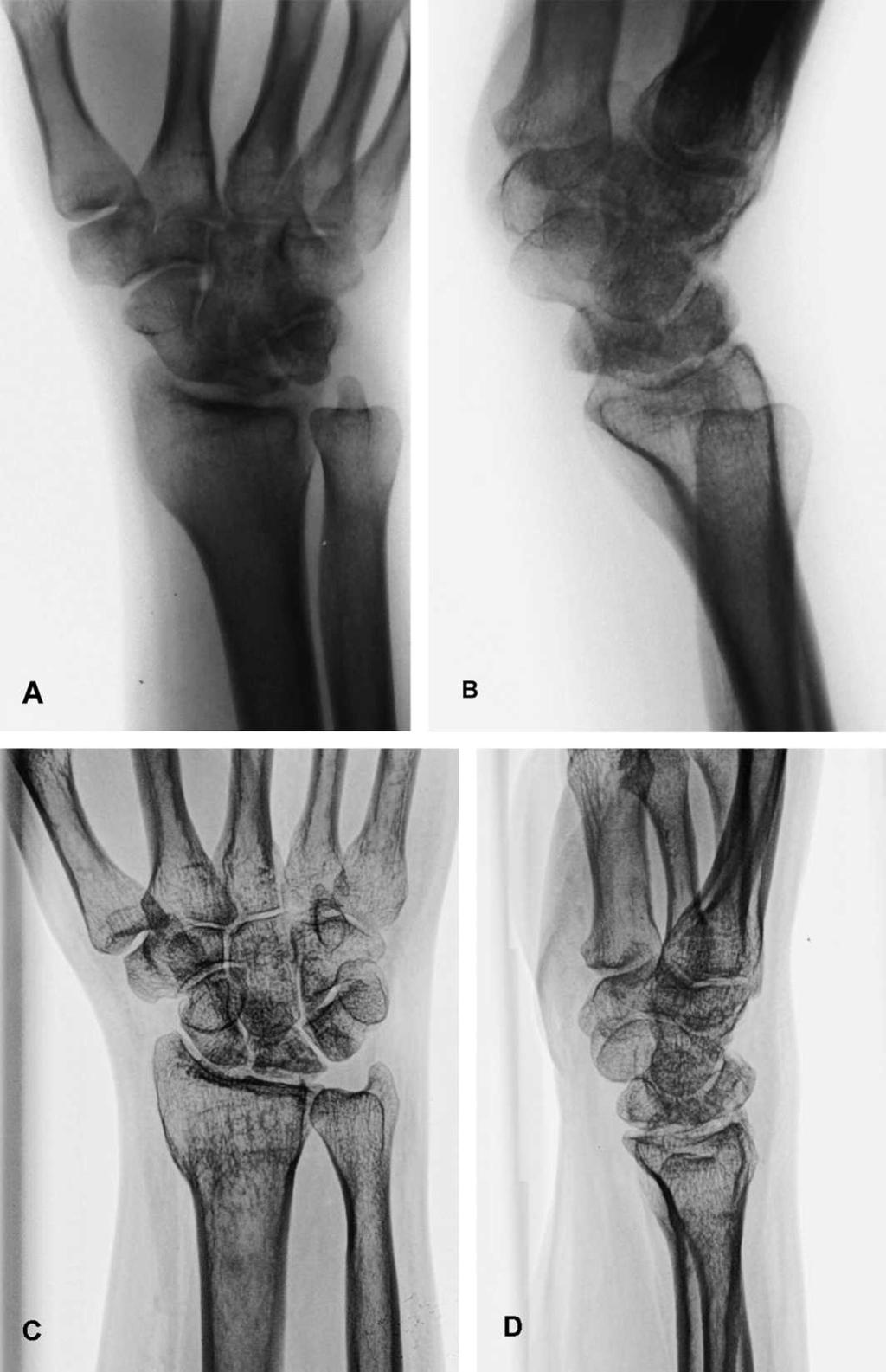 4 Raven et al Clinical Orthopaedics and Related Research Fig 1A D. (A) An anteroposterior radiograph from a 20-year-old woman shows Stage 3B Kienböck s disease on the right (dominant) wrist.