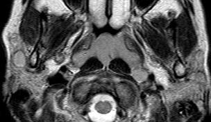 parotid gland, bilateral enlarged lymph nodes and benign lymphoepithelial