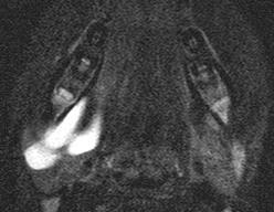 anterior and posterior submandibular space.