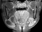 large, ruptures out of posterior sub lingual space into sub mandibular space lacking