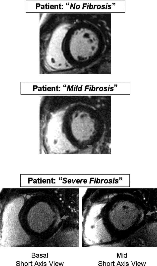 MRI of 3 typical Fabry patients at baseline.