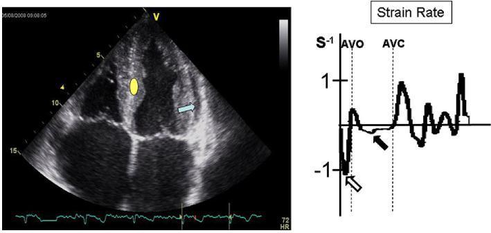 Cardiac amyloidosis is the disease in which longitudinal function is most homogeneously reduced and long. strain is usually <10% Wiedemann et al.