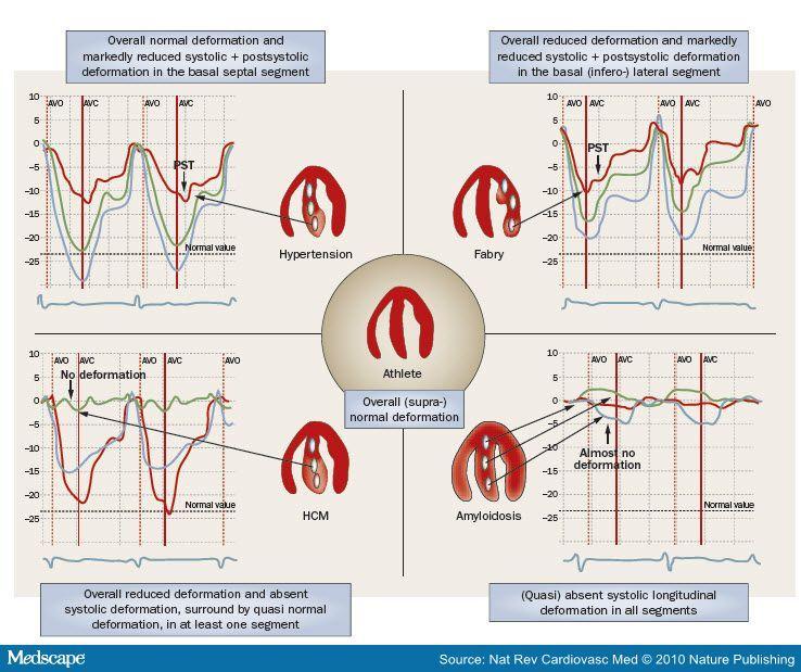 Typical echocardiographic features of the left