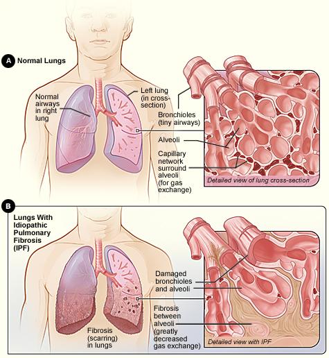 Chronic lung diseases IPF (restrictive) Physiological changes The tissue in the lungs becomes thick and