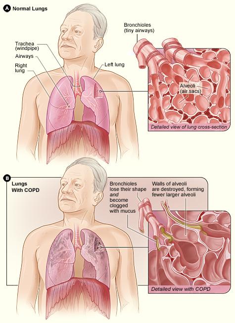 Chronic lung diseases COPD (obstructive) Physiological changes The airways and air sacs (alveoli) lose their elastic quality The walls