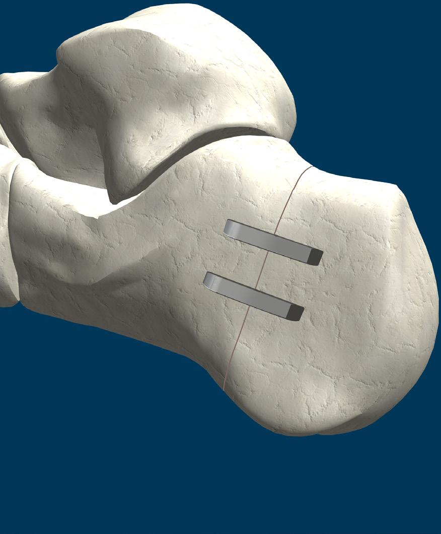 Dwyer Osteotomy Lateral closing wedge osteotomy of the calcaneus.