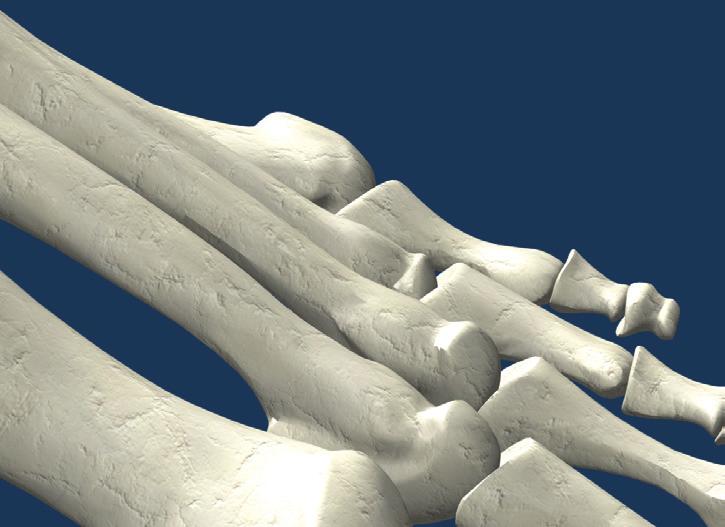 Akin Osteotomy Medial closing wedge osteotomy of the proximal phalange of the Hallux.