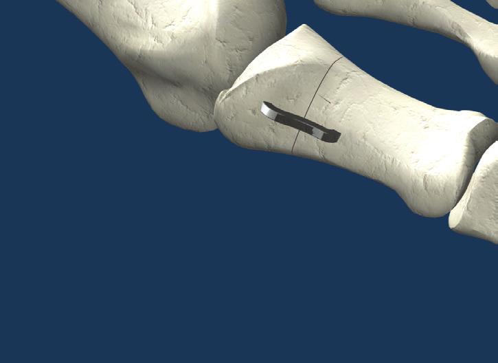 If placement is dorsal or mid shaft medial, use a SPEED Memory Implant.