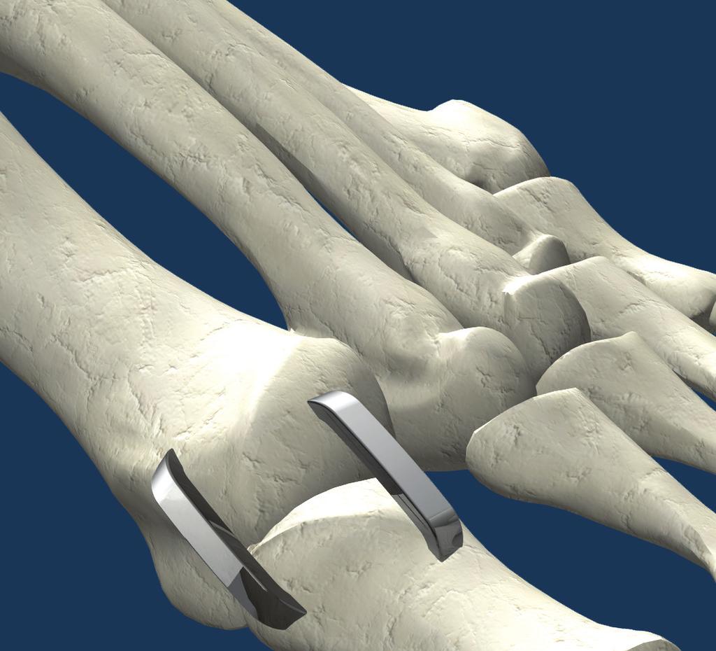 First Metatarsophalangeal (MTP) Joint Arthrodesis Fusion of the proximal phalange of the Hallux and the head