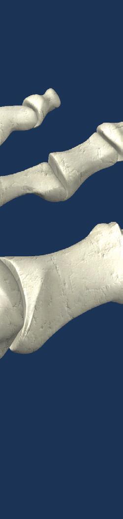 osteotomy near the base of the first