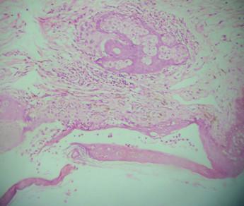 pustular dermatosis (H&E, 10X) Fig.