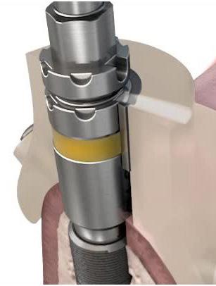 Implant site preparation Immediate Smile for Astra Tech Implant System EV The Immediate Smile solution featuring Atlantis Abutment offers guided surgery and guided soft tissue healing for immediate
