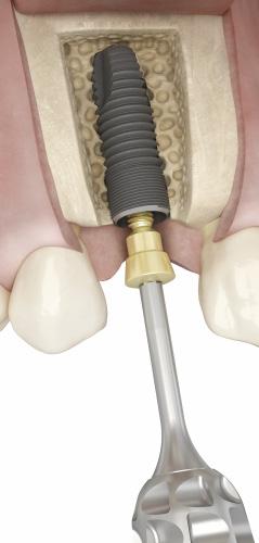 Implant site preparation EV-Stabilization Abutment Finalizing implant installation For multiple implant cases, you can use the