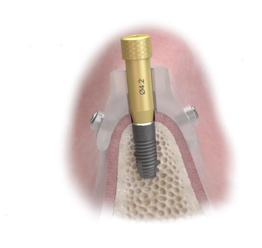 For easier removal, the stabilization abutment should be handtightened using a Hex Driver EV.