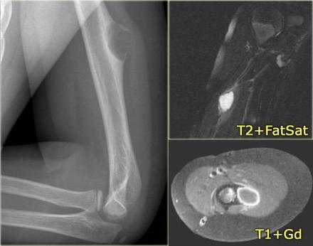 After the administration of Gadolinium there is thick peripheral enhancement. Differential diagnosis based on plain radiograph: giant cell tumor or chondroid lesion, i.e. enchondroma, low grade chondrosarcoma or CMF.