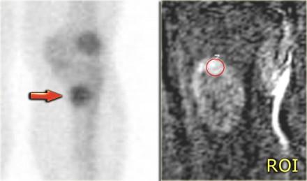 Bone scintigraphy of the same patient shows increased uptake in the lesion. This increased uptake in a chondroid tumor is in favor of the diagnosis of a low grade (grade I) chondrosarcoma.