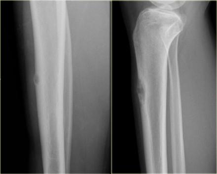 ABC (6) - atypical case On the left two different patients with an intracortical or subperosteal osteolytic well-defined lesion in the tibia.