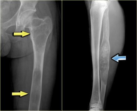 In this patient there are identical lesions within the proximal femur and left acetabulum. There is a groundglass appearance with focal areas of calcifications.