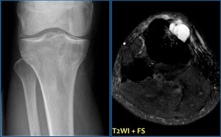 The radiographs show ground glass abnormalities with or without calcifications.