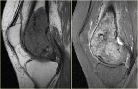 GCT in distal femur Giant cell tumor (2) continued MR-images of the same patient. Sagittal T1-weighted TSE images before and after Gd.