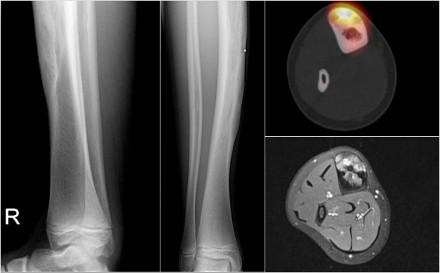 Sagittal T2-weighted fat-suppressed images demonstrate multiple foci of high SI within the cortices of tibia and fibula.