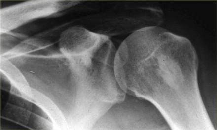Bone island (2) On the left a well-defined compact sclerotic lesion in the proximal humerus. Most likely diagnosis: bone island or enostosis.
