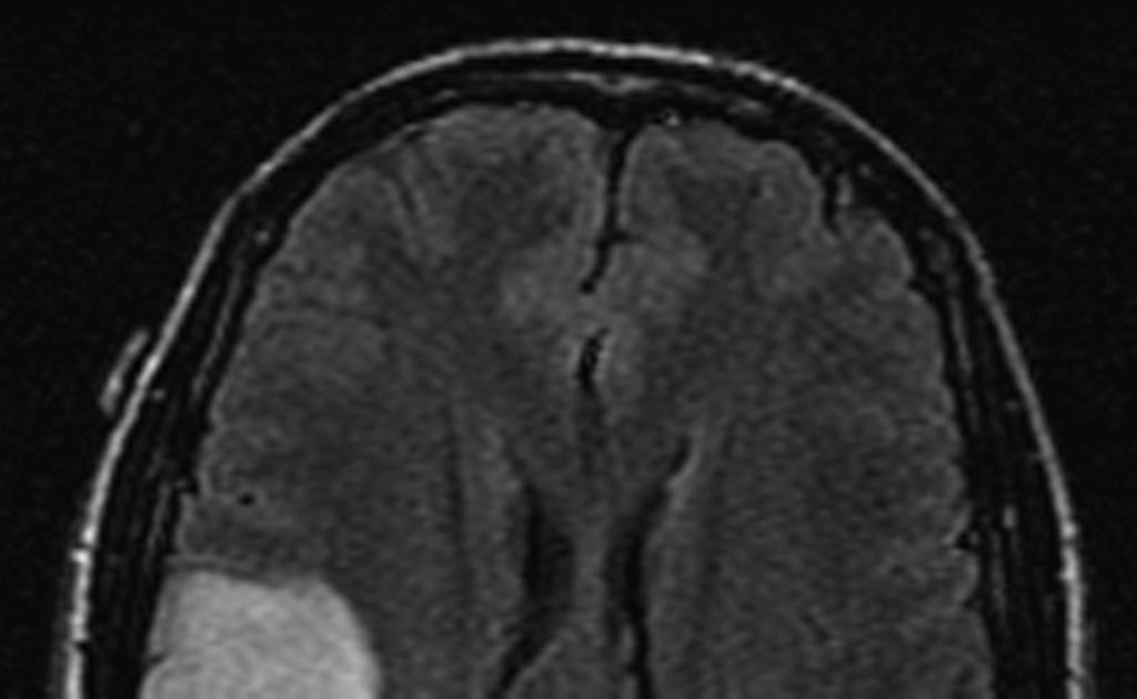 II-III Gliomas MRI 