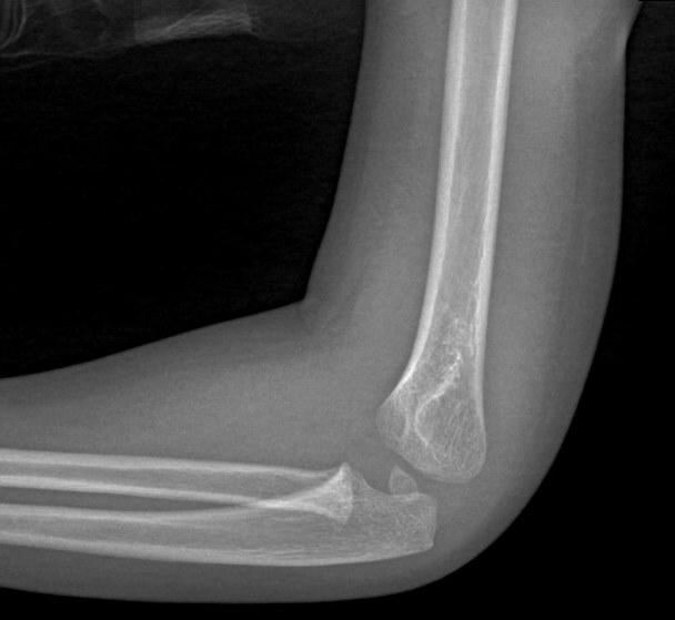 Lateral Humeral Condyle Fractures in