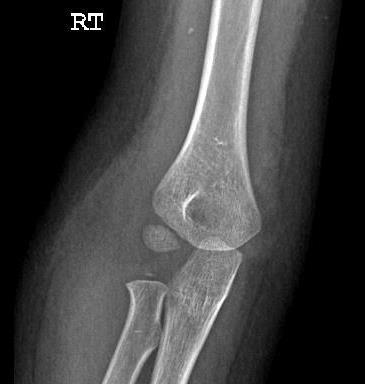 Lateral Humeral Condyle