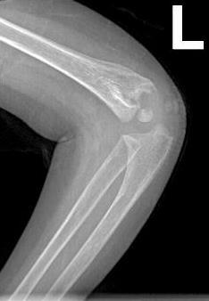Lateral Humeral Condyle