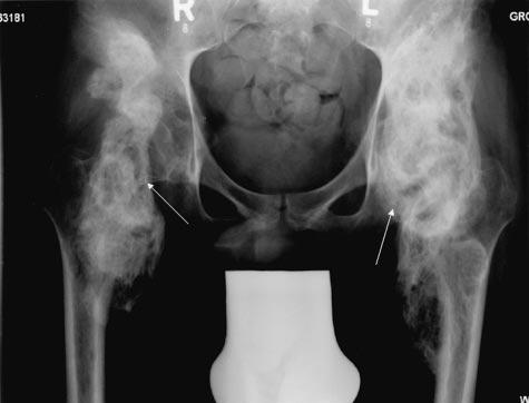 30 Endoprosthesis in prplegics with perirticulr ossifiction of the hip Tle 1 Age (yers)/ Sex Ptients nd outcome ASIA Time of opertion fter primry injury (months) POA pre-op POA t follow-up ROM exion