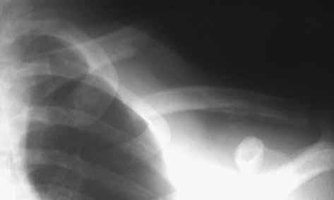 ACUTE MANAGEMENT OF CLAVICLE FRACTURES 305 a Operative treatment was applied primarily in the remaining 11 patients and in the 4 cases with nonunion after conservative treatment.