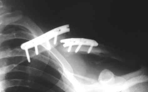 The last case a mid-diaphysis clavicle fracture ended with nonunion and plate breakage after ORIF (fig 1). Despite fracture union, approximately one third of patients (44 patients = 31.
