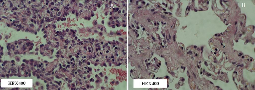 Fig. 5: NSIP. Photomicrograph (hematoxylin-eosin stain, x400) showing cellular (A) and fibrotic (B) patterns of NSIP.