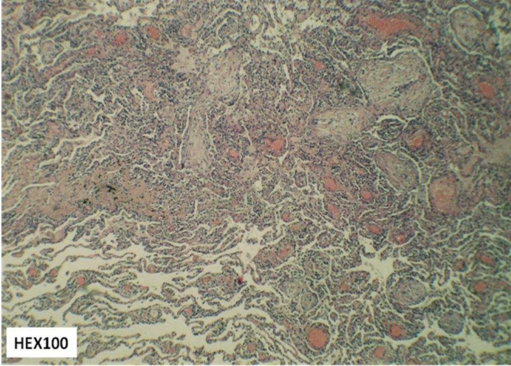 Fig. 8: Fibrotic NSIP in a patient treated with methotrexate: bilateral reticular opacities and ground-glass opacity, as well as architectural distortion and traction bronchiectasis indicating