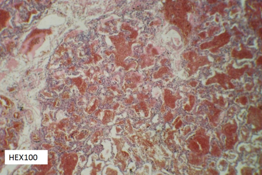 Fig. 12: PH (hematoxylin-eosin stain, x100): alveolar spaces occupied by fibrin mixed with red blood cells.