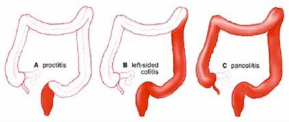 Symptoms may include Abdominal pain Diarrhoea (sometimes mixed with blood, especially in Ulcerative Colitis) Tiredness and fatigue Loss of appetite Weight loss Abscesses and fistulas (in Crohn s)