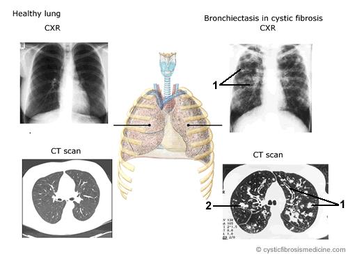 Cystic Fibrosis Complications Respiratory system Bronchiectasis Chronic