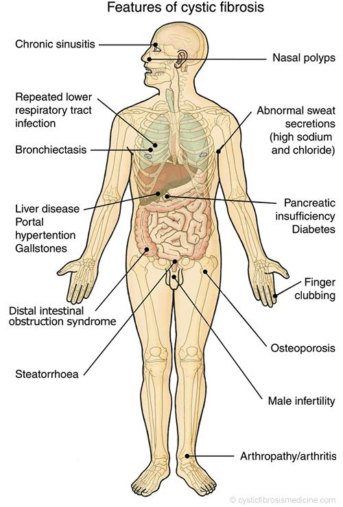 Cystic Fibrosis Complications Systemic complications Nutritional deficiencies Diabetes Osteoporosis Blocked bile duct Rectal