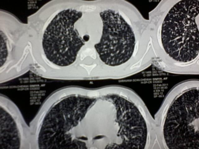 chest CT