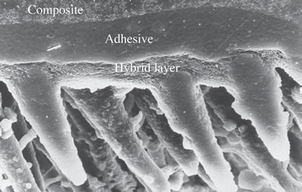 Background The open dentin tubules create a surface where adhesive can penetrate and form resin tags.