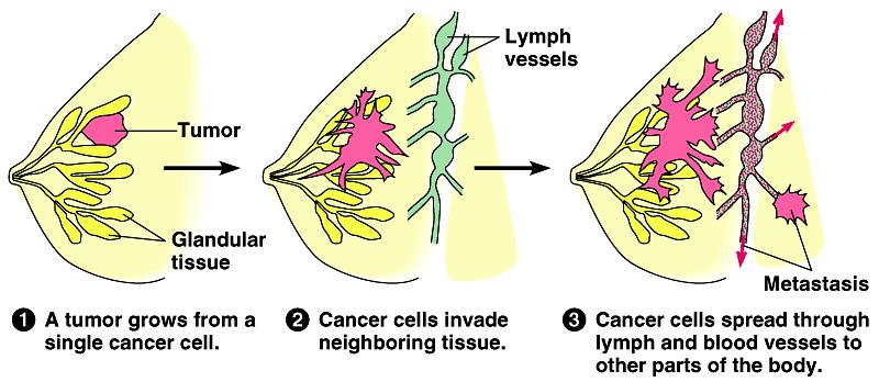 Tumors Malignant tumor cells leave original site carried by circulatory