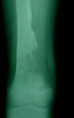 Which part of the bone: Epiphyseal, Metaphyseal or Diaphyseal 4.