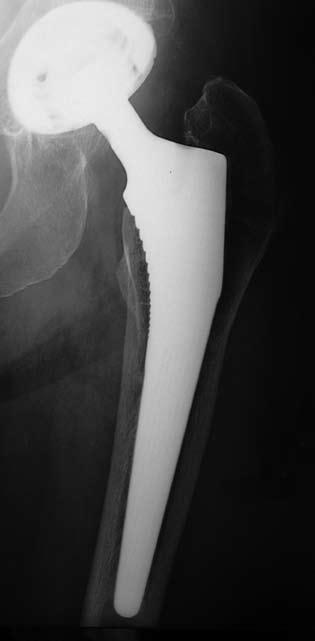 18 years post-op Compaction broaching coupled with Corail creates silent hip replacement. We don t see any adverse, long-term radiographic changes.