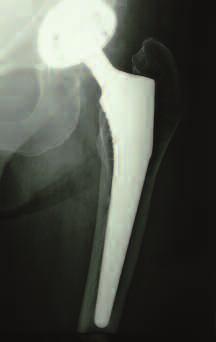 hilosophy Compaction broaching coupled with Corail creates silent hip replacement. We don't see any adverse, long-term radiographic changes.