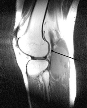 Following gadolinium administration, axial T1-weighted MRI with fat saturation shows avid enhancement of the soft tissue components of the mass that abuts but does not invade the subjacent femur.