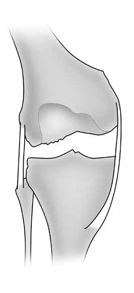 Release of the insertion of the semimembranosus muscle from the posteromedial tibia, or the pesanserinus tendons, is occasionally necessary.