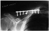 plating Intramedullary fixation Clavicle