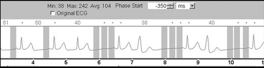 Example of data set with premature beats before (A C) and after (D F) ECG editing obtained in