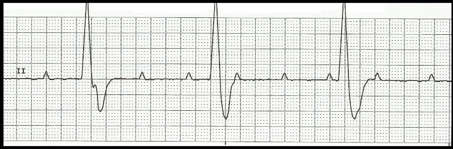 24. A patient with mitral regurgitation develops atrial fibrillation with a rate of 88, B/P of 118/75. Which of the following may be indicated? a. Beta blockers and vasopressors b.